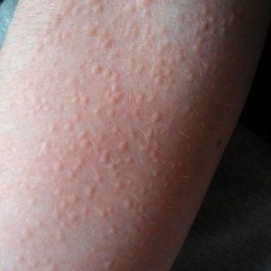 krapivnitsa